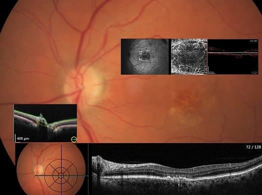 macular scan